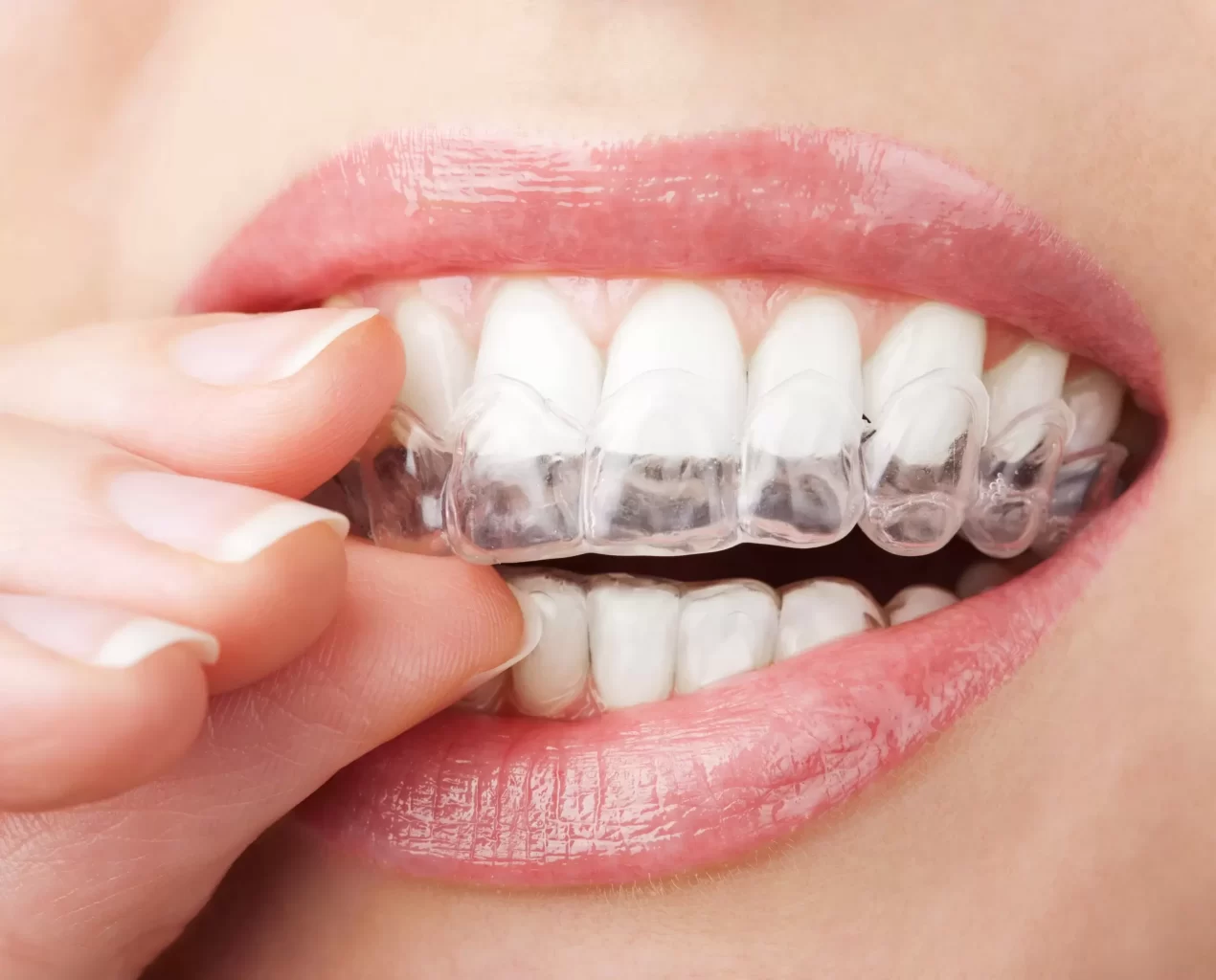 Woman putting Invisalign aligner in her mouth