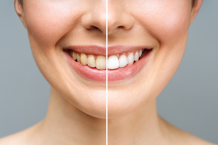 Woman teeth before and after whitening. 