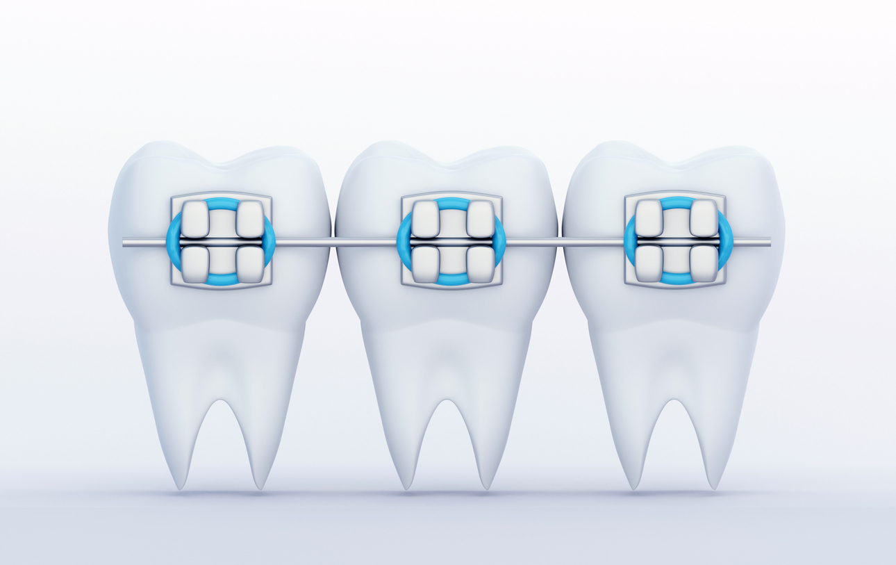 braces on teeth vector image