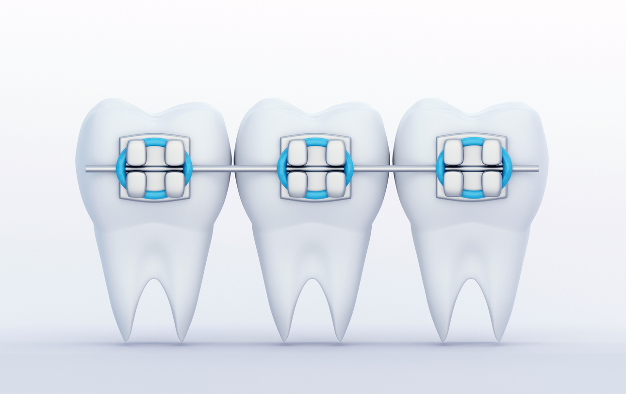 braces on teeth vector image