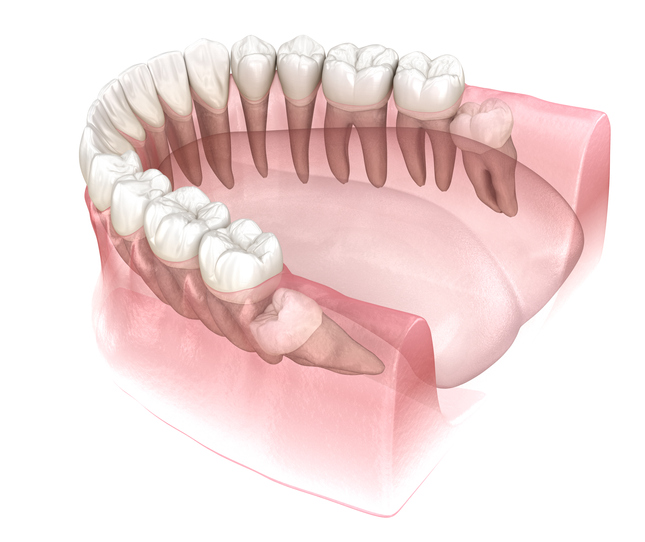Mesial impaction of Wisdom tooth. Medically accurate tooth 3D illustration